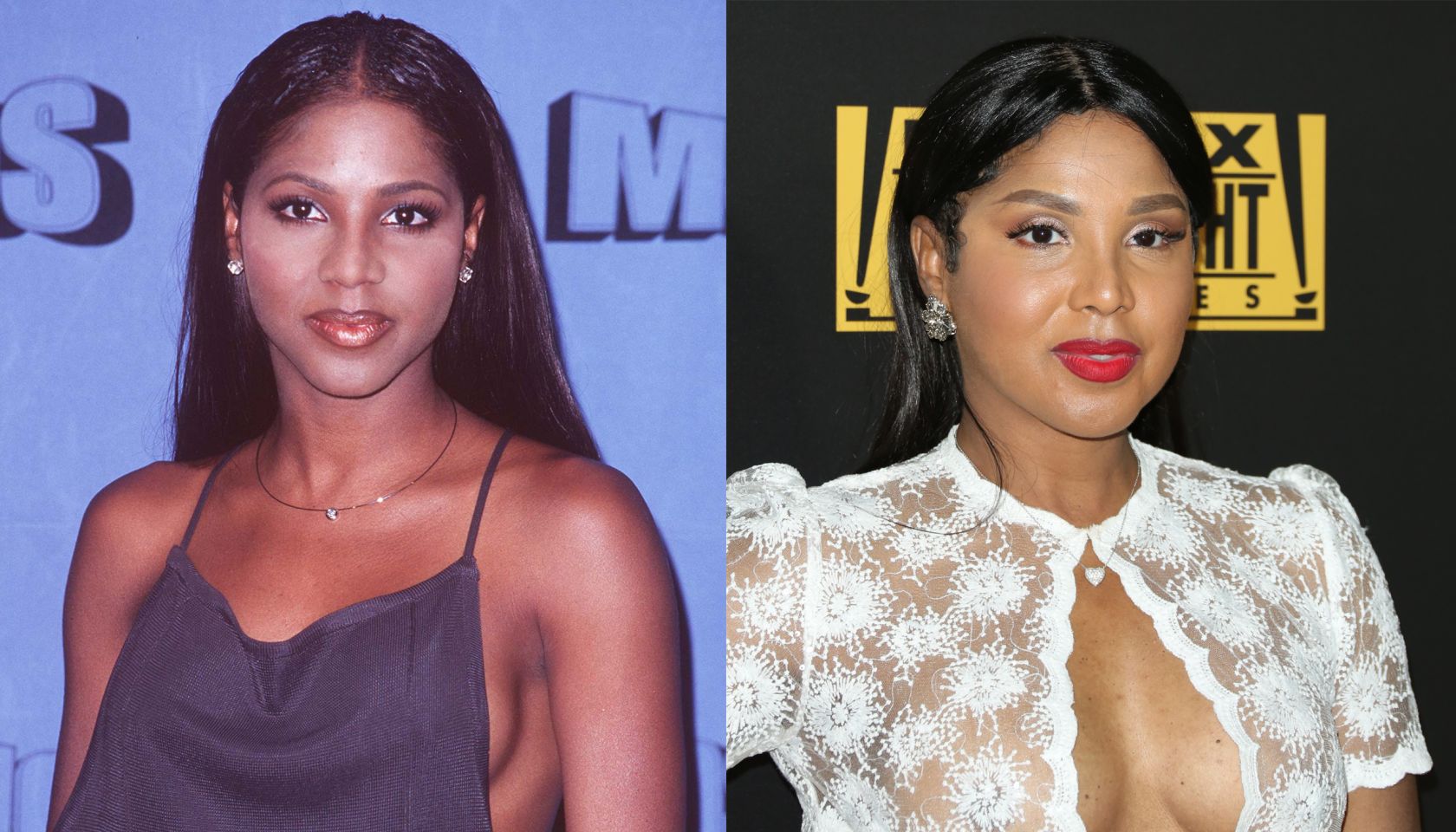 Toni Braxton Plastic Surgery