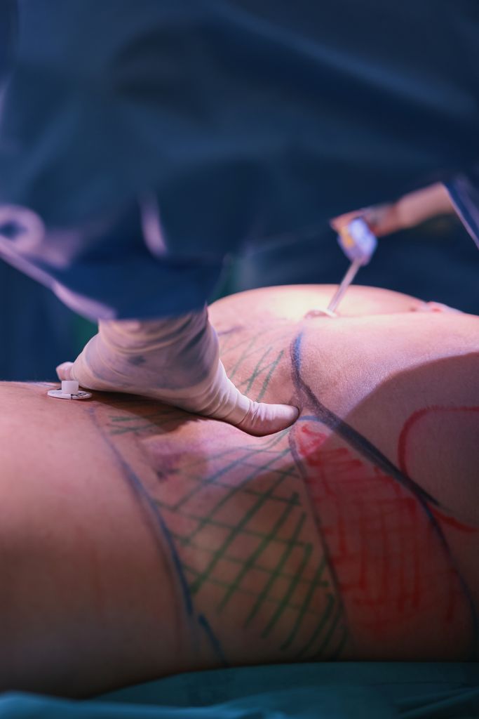 High definition liposuction in the operating room